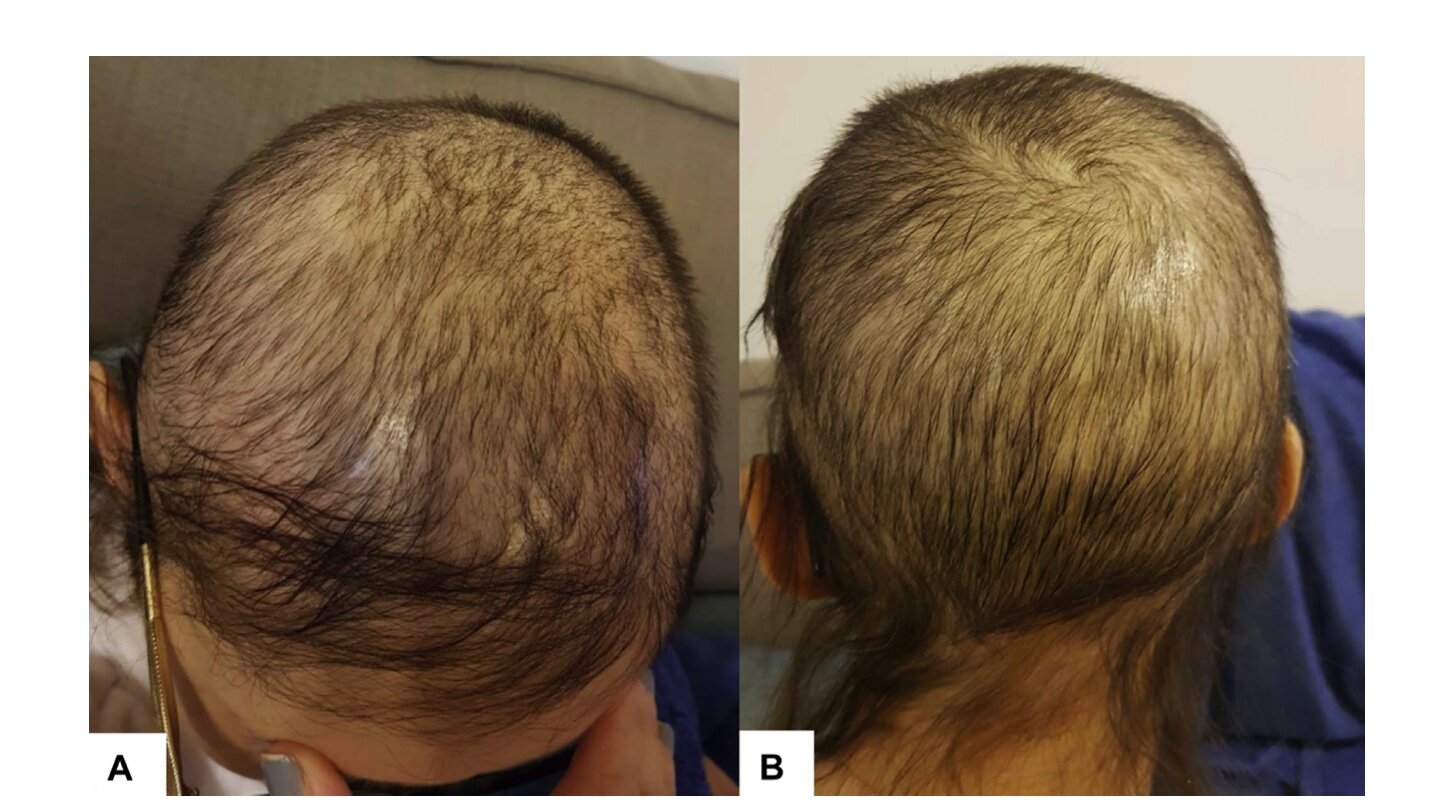 Oral Minoxidil For Permanent Chemotherapy Induced Alopecia Donovan